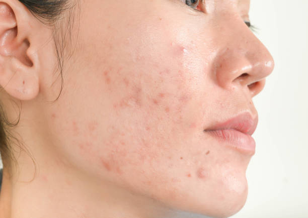 Skin Acne